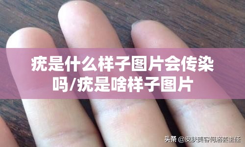 疣是什么样子图片会传染吗/疣是啥样子图片