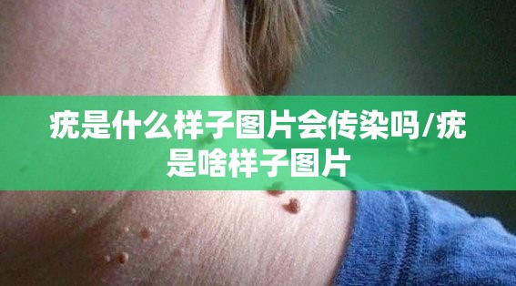 疣是什么样子图片会传染吗/疣是啥样子图片