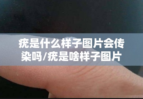 疣是什么样子图片会传染吗/疣是啥样子图片