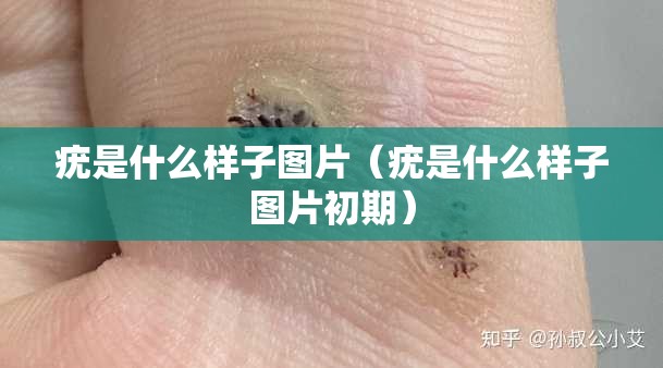 疣是什么样子图片（疣是什么样子图片初期）