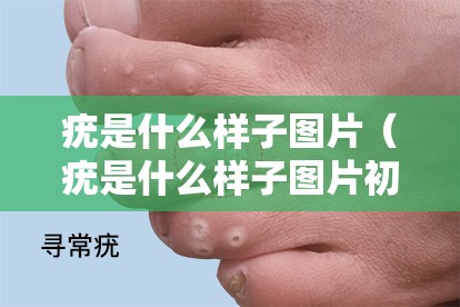 疣是什么样子图片（疣是什么样子图片初期）