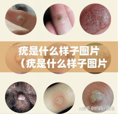 疣是什么样子图片（疣是什么样子图片初期）