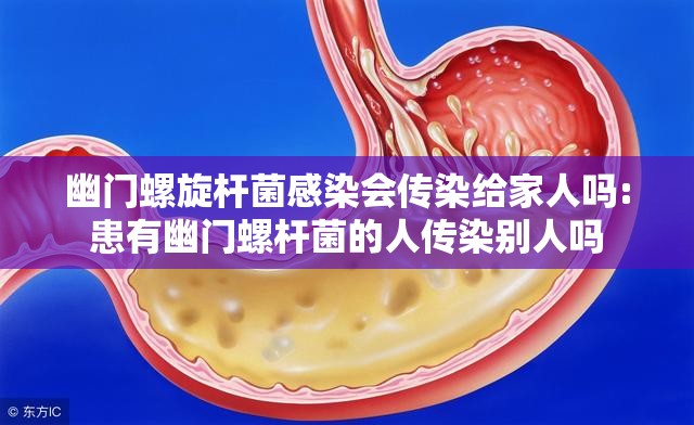 幽门螺旋杆菌感染会传染给家人吗:患有幽门螺杆菌的人传染别人吗